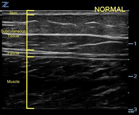 ultrasound test of soft parts|soft tissue ultrasound results.